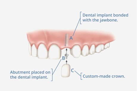 Dental Implants Monroe, WA 